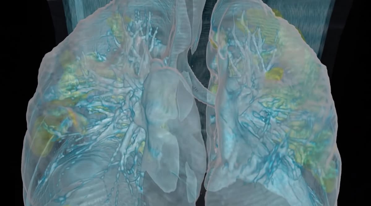 Lung Damage in Coronavirus Patients: Video by Washington DC Hospital Releases a VR Fly-Through of COVID-19 Positive Patient's Lungs Lung Damage in Coronavirus Patients: Video by Washington DC Hospital Releases a VR Fly-Through of COVID-19 Positive Patient's Lungs