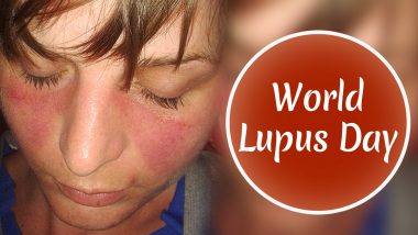 World Lupus Day 2020: Patients with Autoimmune Diseases Should Be Extra Cautious About COVID-19, Say Doctors