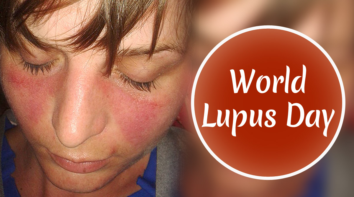 Lupus what is Lupus Symptoms