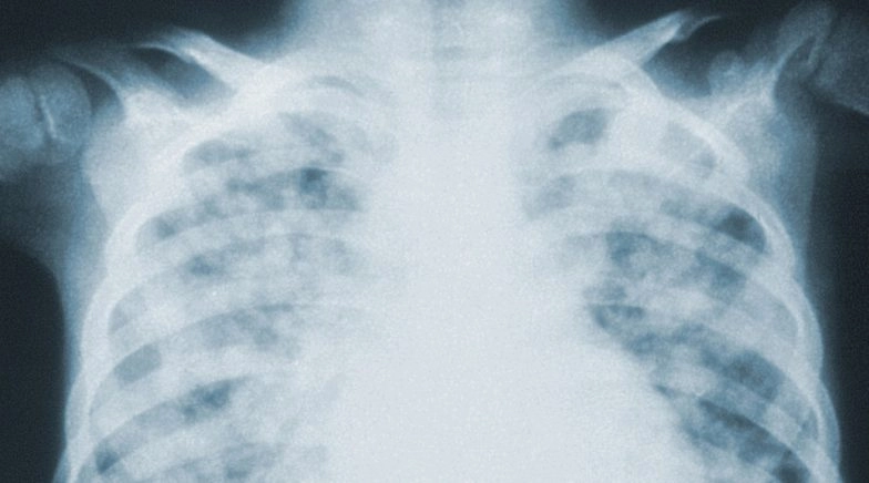 Chinese Man's Lungs Infested with Worms After Eating Raw Snake Gallbladder 