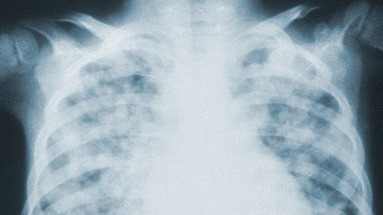 Chinese Man's Lungs Infested with Worms After Eating Raw Snake Gallbladder and Other Exotic Seafood; Know More About Paragonimiasis, the Lung Fluke Disease