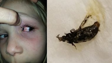 Little Girl Gets Beetle Stuck Alive in Her Eye For 9 Hours But Shows Courage and Keeps a Name For It! Terrifying Pics Go Viral