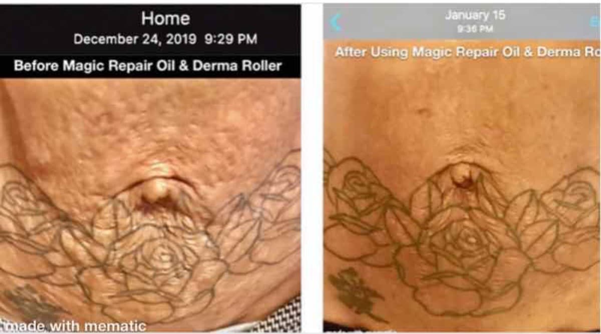 'How to Get Rid of Stretch Marks & Scars Naturally, Seriously' 'How to Get Rid of Stretch Marks & Scars Naturally, Seriously'