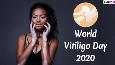 World Vitiligo Day 2020 Date, History and Significance: Know About This Day Observed to Raise Awareness About The Skin Condition