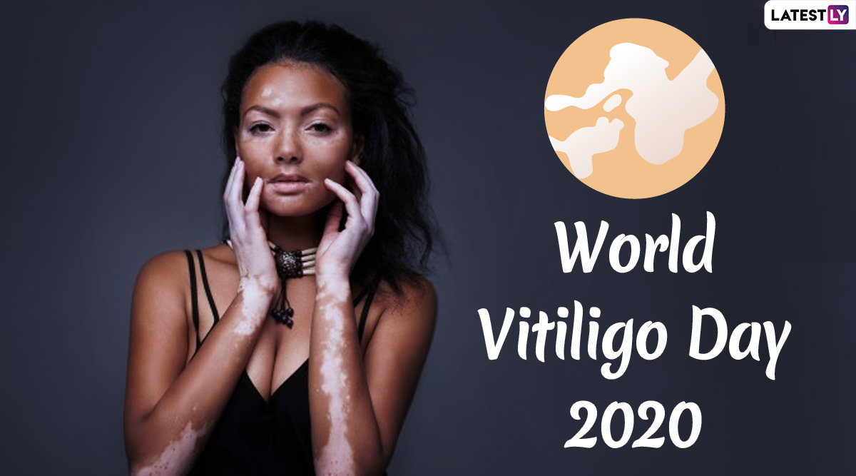 Festivals And Events News World Vitiligo Day 2020 Date History And Significance To Raise 0349