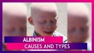 International Albinism Awareness Day 2020: Causes, Types And Diagnosis Of This Genetic Disorder