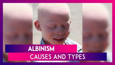 International Albinism Awareness Day 2020: Causes, Types And Diagnosis Of This Genetic Disorder