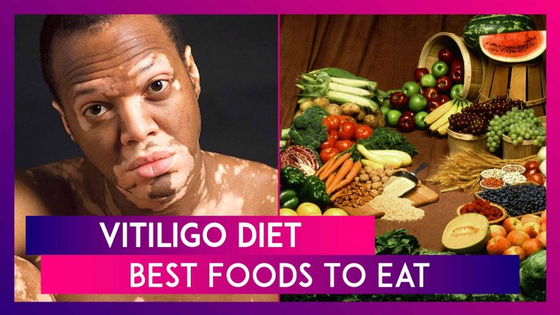 World Vitiligo Day 2020: Diet To Stop The Progression Of The Skin Disease