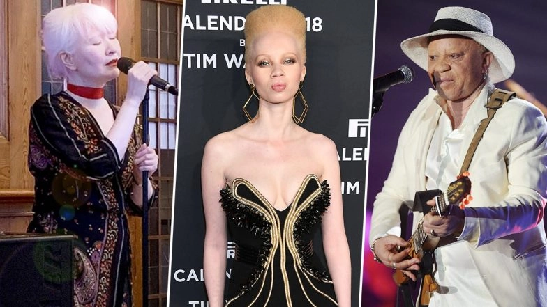 International Albinism Awareness Day 2020: Famous Albino Personalities Who Didn't Let Their Skin Disorder Hamper Their Big Dreams