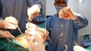 Guwahati Man Approaches Hospital After Abdominal Pain, Doctors Find Mobile Charger in His Urinary Bladder as Result of Masturbation