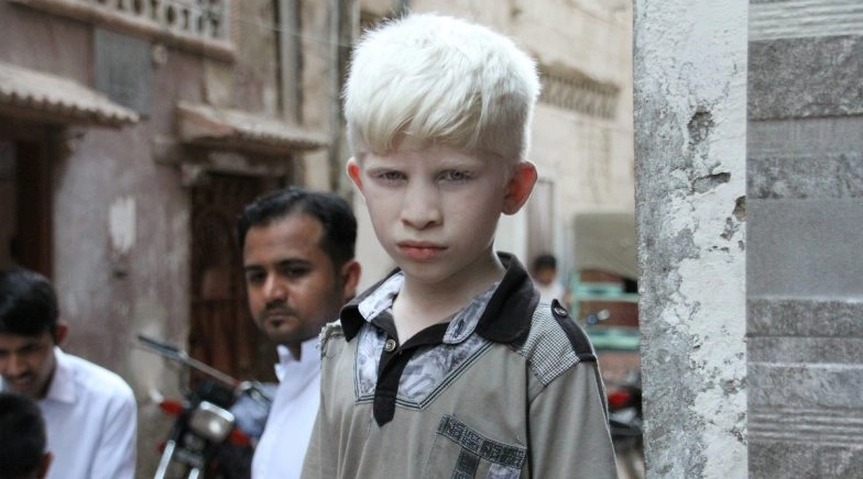 International Albinism Awareness Day 2020 Date & Theme: Know the History and Significance