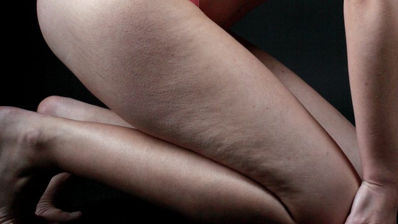 Want to Get Rid of Butt Cellulite? A New Injectible Treatment Gets FDA Approval! Know More About New Technique to Smoothen Skin