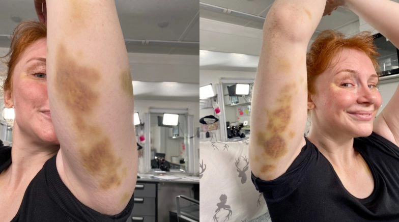 Chris Makes Bryce Show Her Bruises As Jurassic World: Dominion Resumes Shooting in London