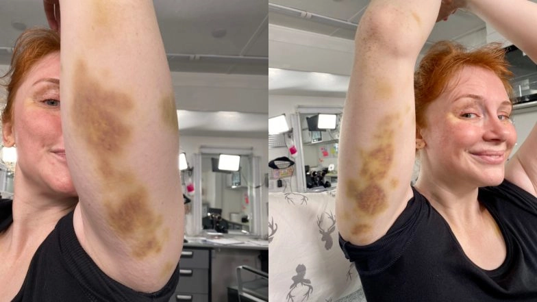 Chris Pratt Makes Bryce Dallas Howard Show Her Bruises As Jurassic World: Dominion Resumes Shooting in London