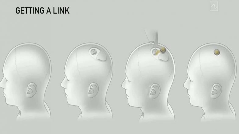 Elon Musk Unveils Pig Implanted With Brain Chip, From Anxiety Relief to Solving Dementia, Here's How Neuralink's AI Technology Could Benefit Humans in Future