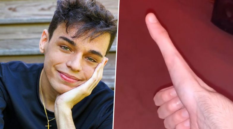 21-Year-Old Massachusetts Student Jacob Pina's 5-Inch-Long Thumb Amazes Netizens, Videos Go Viral