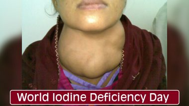 World Iodine Deficiency Day 2020: Causes, Symptoms & Treatment of the Deficiency That May Cause Goiter, Thyroid Problems and Even Mental Disabilities