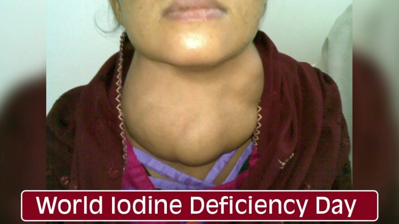 When is World Iodine Deficiency Day 2020? Know More About Causes, Symptoms & Treatment