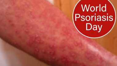 World Psoriasis Day 2020: From Genital to Scalp Psoriasis, Types of The Autoimmune Disease That you Must Know Of