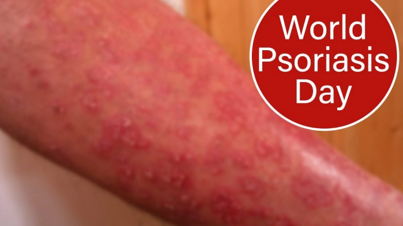 Psoriasis Day 2020: From  Genital to Scalp Psoriasis, Types of The Autoimmune Disease