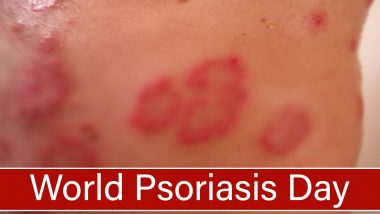 World Psoriasis Day 2020 Date, History & Significance: Know More about the Autoimmune Skin Disease and Difficulties Related to It
