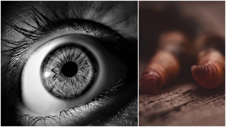 Disturbing! 20 Live Worms Remove From Chinese Man's Eyelid, Other Instances When Parasitic Worms Were Found in Patient's Pupils (Watch Scary Videos)