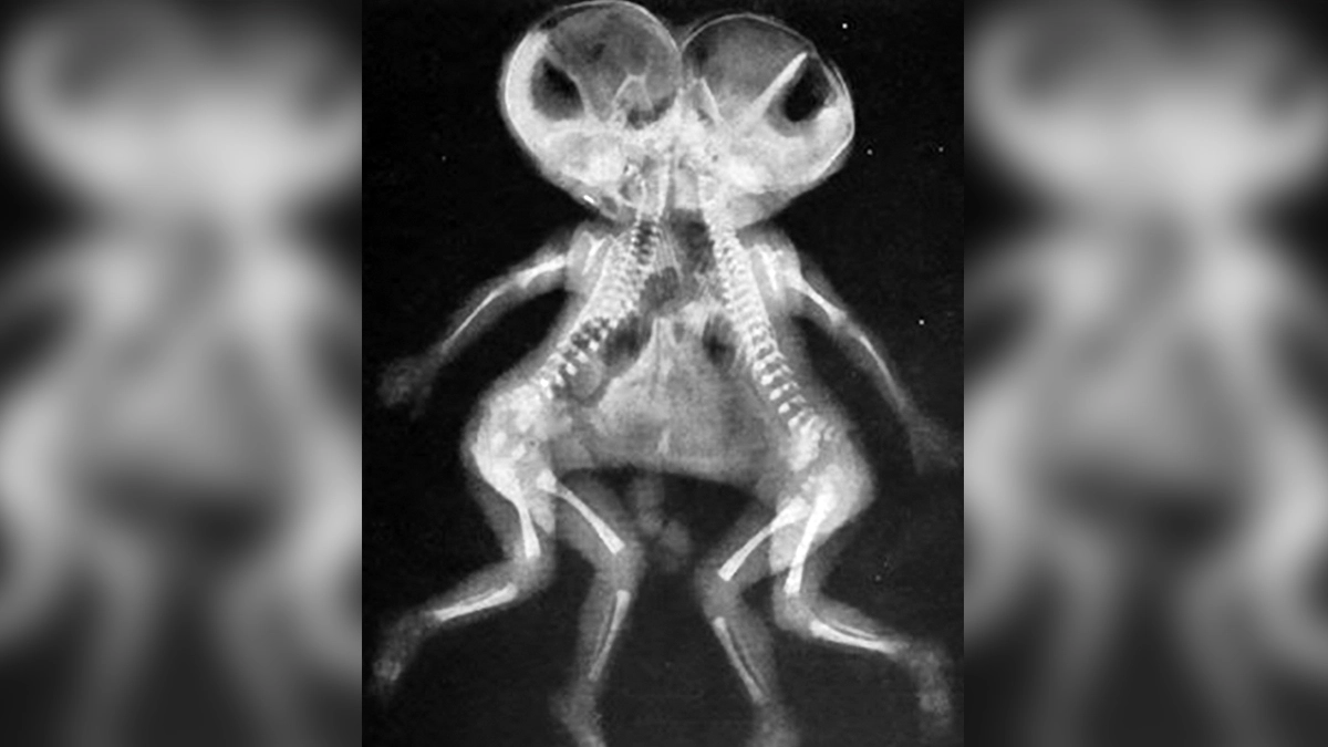 India News | Siamese Twins Separated Successfully at UP's King George's  Medical University | 📰 LatestLY, image size:1200x675