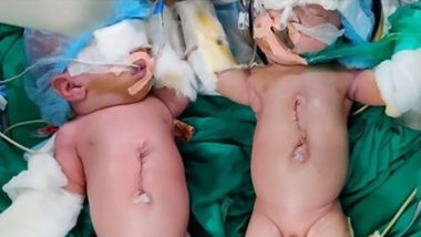 Conjoined Twin Sisters Separated in Rare Surgery at Mumbai's Wadia Hospital