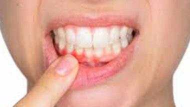 psoriasis bleeding gums