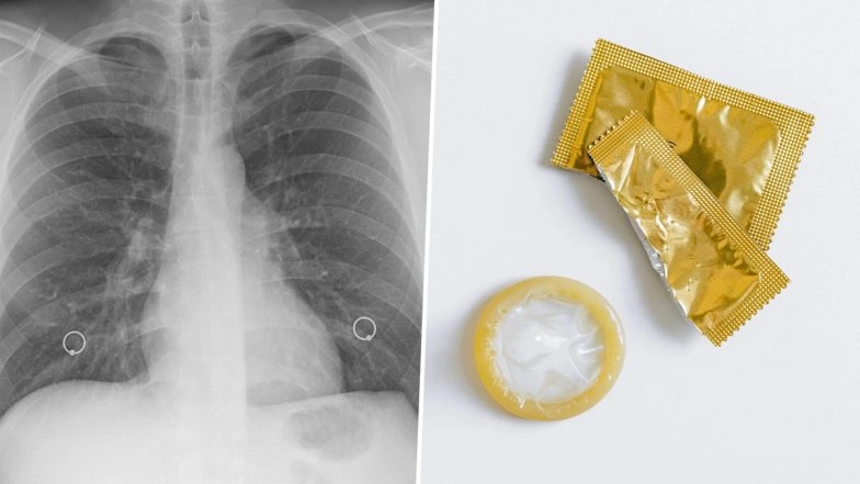 Woman Thinks She Has TB, but It Was Condom Stuck in Her Lung
