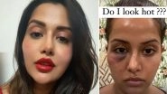 Raiza Wilson Shares Her Picture Post the Botched-Up Dermatological Procedure, Asks &lsquo;Do I Look Hot?&rsquo;