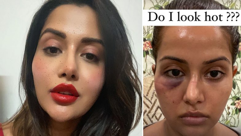 Raiza Wilson Shares Her Picture Post the Botched-Up Dermatological Procedure, Asks ‘Do I Look Hot?’