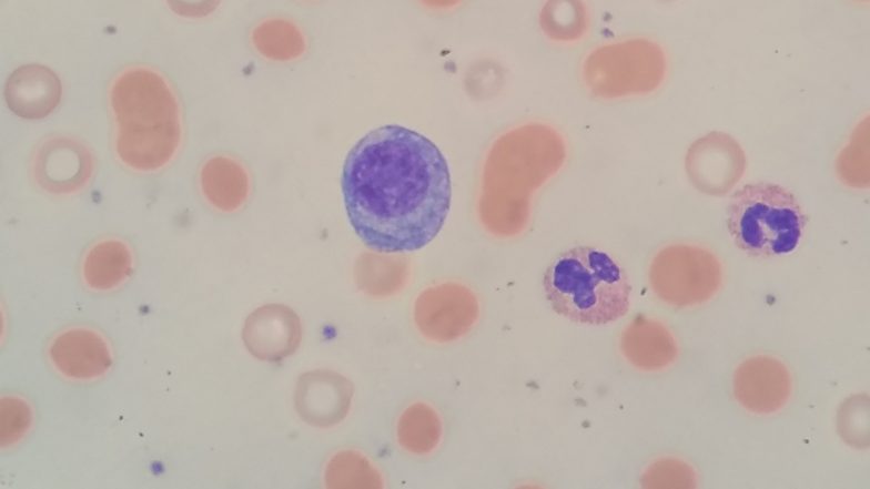 Multiple Myeloma: Know More About Kahler's Disease, a Type of Blood Cancer, Its Symptoms, Causes and Treatment