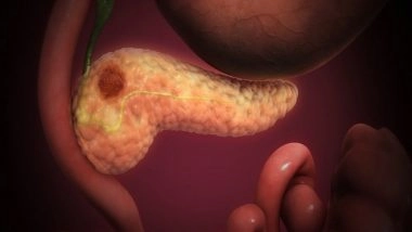 Health News | Study Focuses on Improving Survival in Pancreatic Cancer