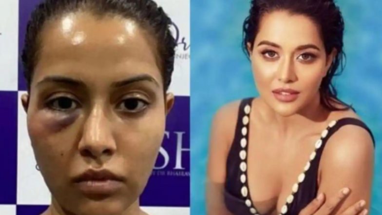 Raiza Wilson Sues Her Dermatologist For Rs 1 Crore for Allegedly Putting Her Life at Risk With a ‘Wrongful Procedure’