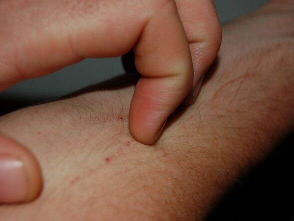 Skin Infections Can Cause Rheumatic Fever: Study