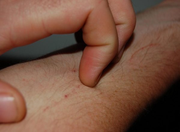 Wildfire Smoke Linked to Skin Disease, Reveals Study
