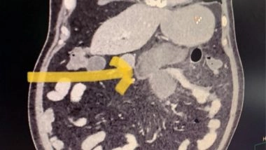 India News | Delhi Hospital Reports Black Fungus of Small Intestine