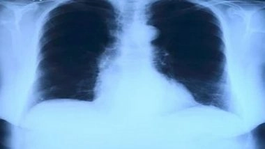 Science News | AI Tool Uses Chest X-ray to Differentiate Worst Cases of COVID-19: Study