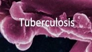 Science News | Novel Tuberculosis Regimen Shortens Treatment Course for Patients
