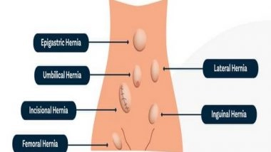 Business News | What Happens After Laparoscopic Hernia Surgery?