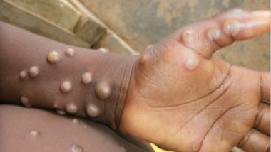 What Is Monkeypox? Texas Man Found Infected With Viral Illness Caused by Monkeys, Know Its Symptoms, Transmission and Treatment