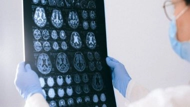 Health News | Study Identifies Potential New Treatment Targets for Alzheimer's Disease