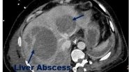 India News | Unusual Large, Multiple Liver Abscesses Found in Patients Recovered from COVID-19