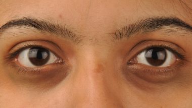 How to Get Rid of Dark Circles: From Consuming Superfoods to Quick Home Remedies, Natural Ways to Manage Periorbital Hyperpigmentation (POH)