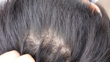 How to Get Rid of Dandruff: From Camphor-Coconut Oil Mix to Curd, Natural Home Remedies to Get Dandruff-Free Long Hair