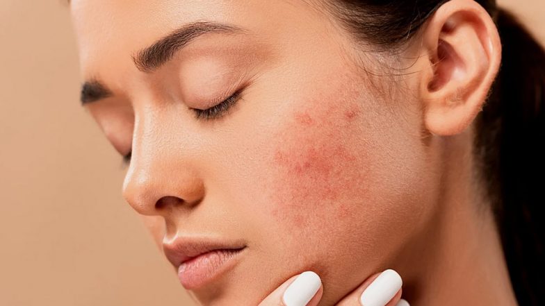 How to Get Rid of Pimples: From Tea Tree Oil to Aloe Vera, Natural Ways to Get Acne-Free Skin at Home