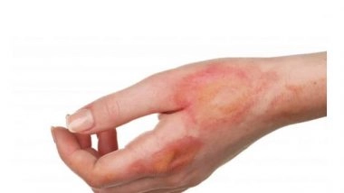 Health News | Light Therapy May Accelerate Healing of Burns: Study