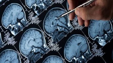 Genetic Risk Scores Can Aid Accurate Diagnosis of Epilepsy: Study