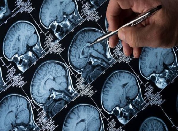 Genetic Risk Scores Can Aid Accurate Diagnosis of Epilepsy: Study